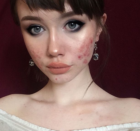 Звездой Instagram стала девушка, не скрывающая акне
