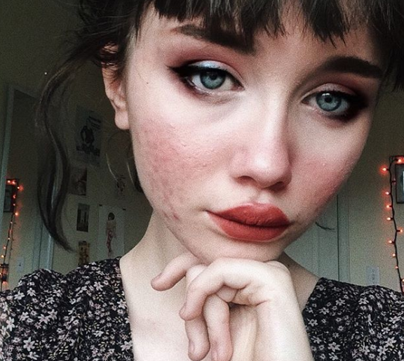 Звездой Instagram стала девушка, не скрывающая акне