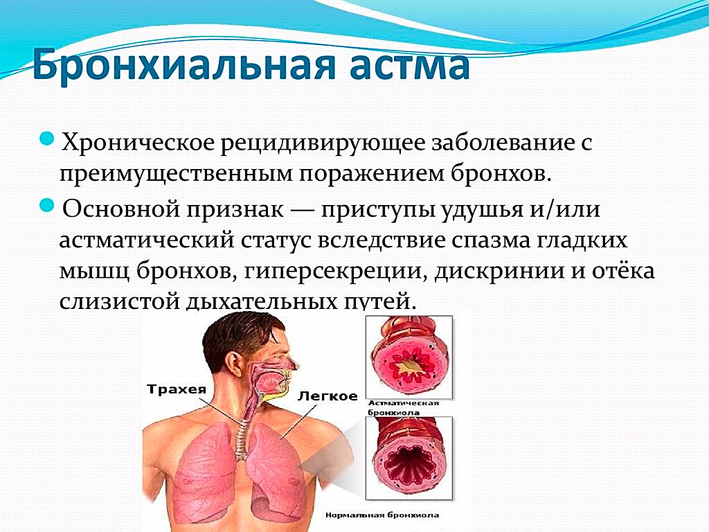 Бронхиальная астма: признаки, лечение и профилактика