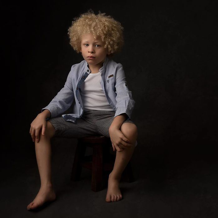 Как очаровательный мальчик-альбинос стал моделью и всеобщим любимцем