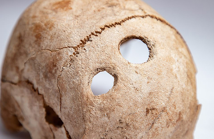 Археологическая находка в Приднестровье доказывает, что 4000 лет назад умели делать трепанацию черепа