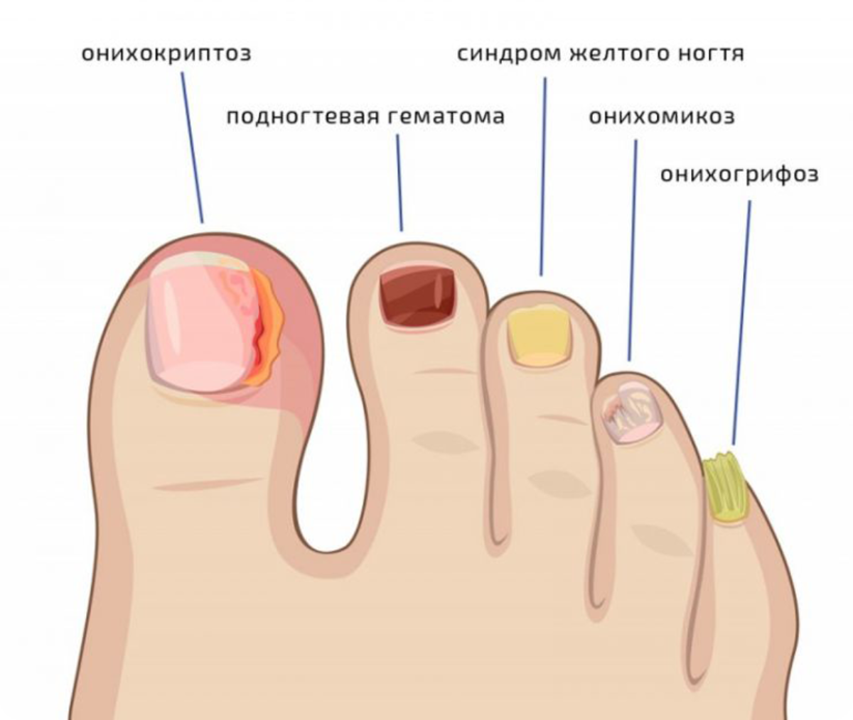 Что означает белые ногти на ногах. Онихомикоз ногтевой пластины. Дистально латеральный онихомикоз.