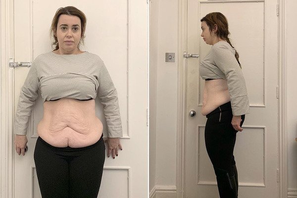 Похудела и пожалела: сбросившая 70 кг британка поделилась ужасной историей