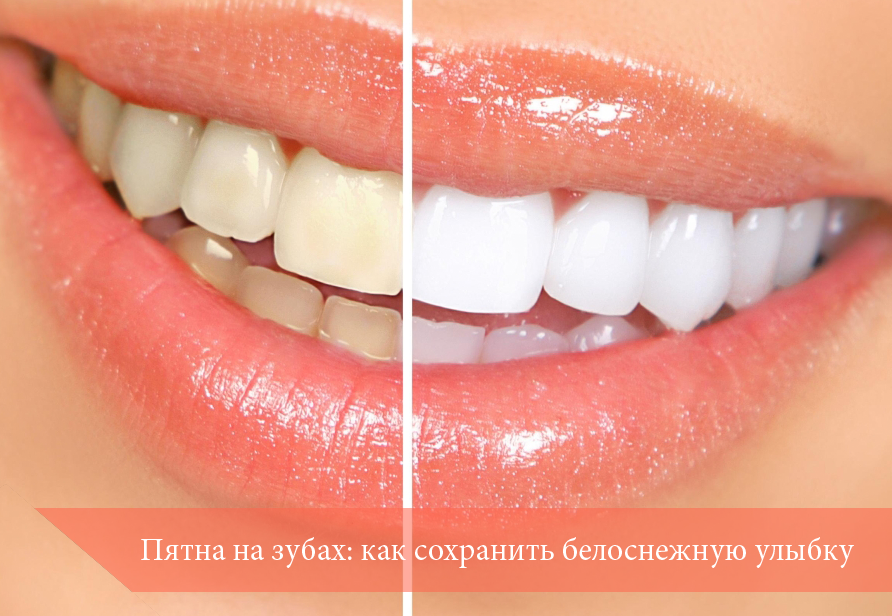 Пятна на зубах: как сохранить белоснежную улыбку