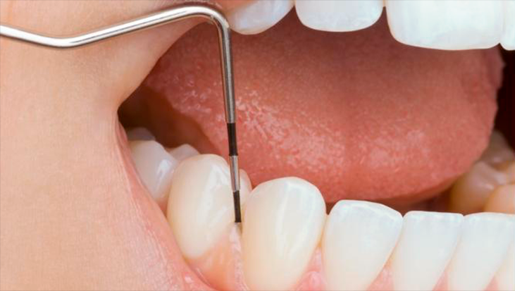 Що таке скейлінг у стоматології?