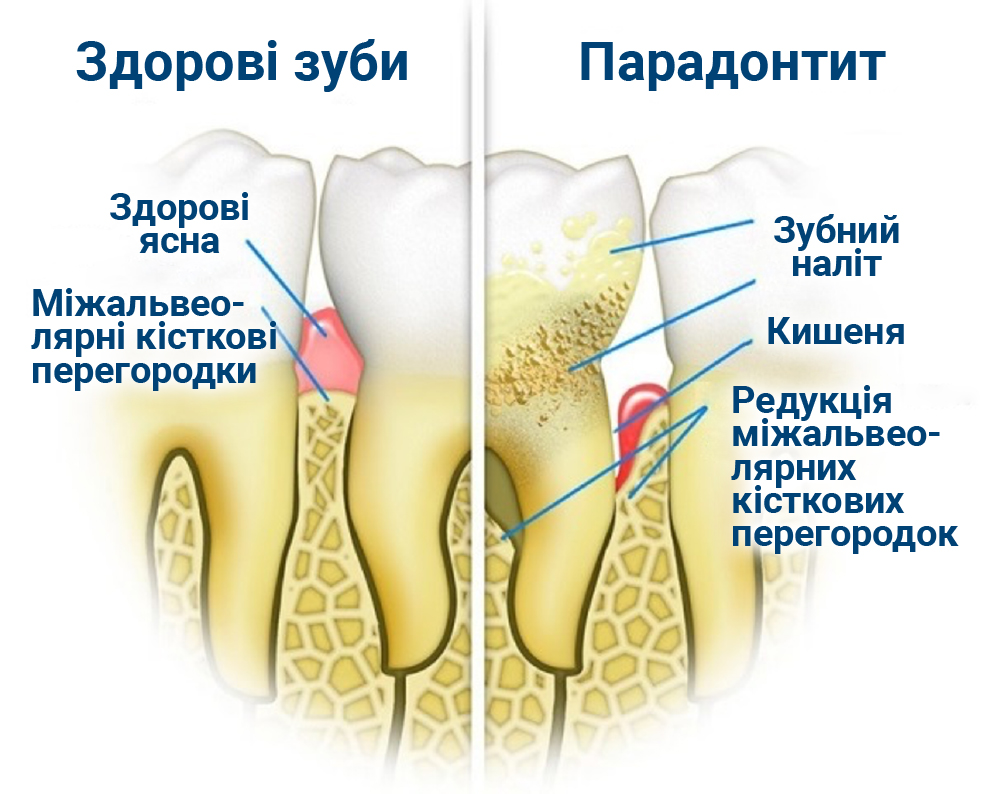 Що таке скейлінг у стоматології?