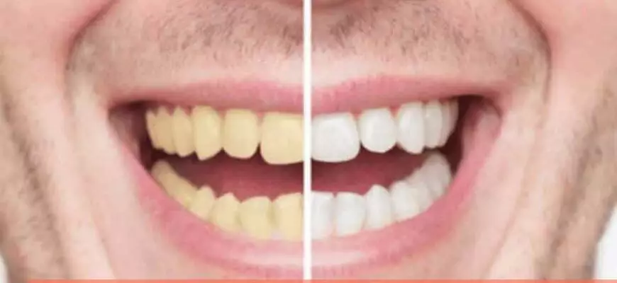 Неужели жёлтые лучше белых? Мифы и правда о зубах